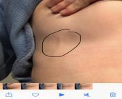 When I pull my breast up, I have this long lump. Tender to the touch. Internet tells me breast cancer is usually a lump rather than long like this. Could it be cancer? from lump com